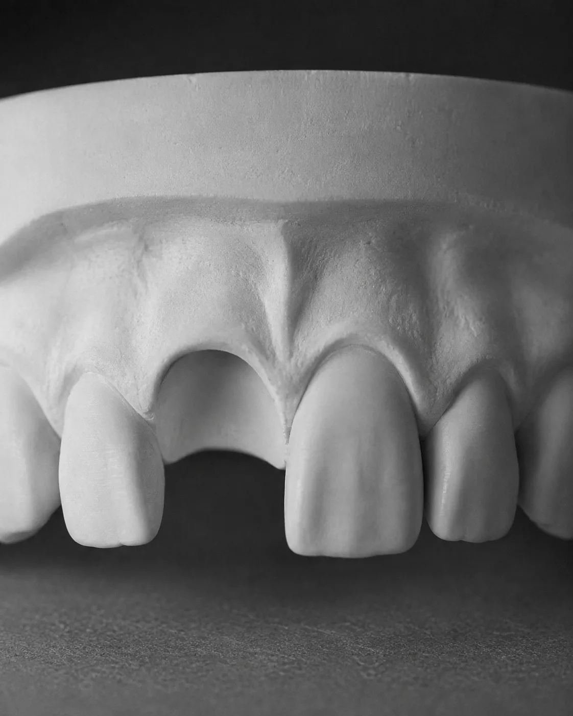 AI-generated dental teaching model: implants before. Illustrative only; not a patient outcome.