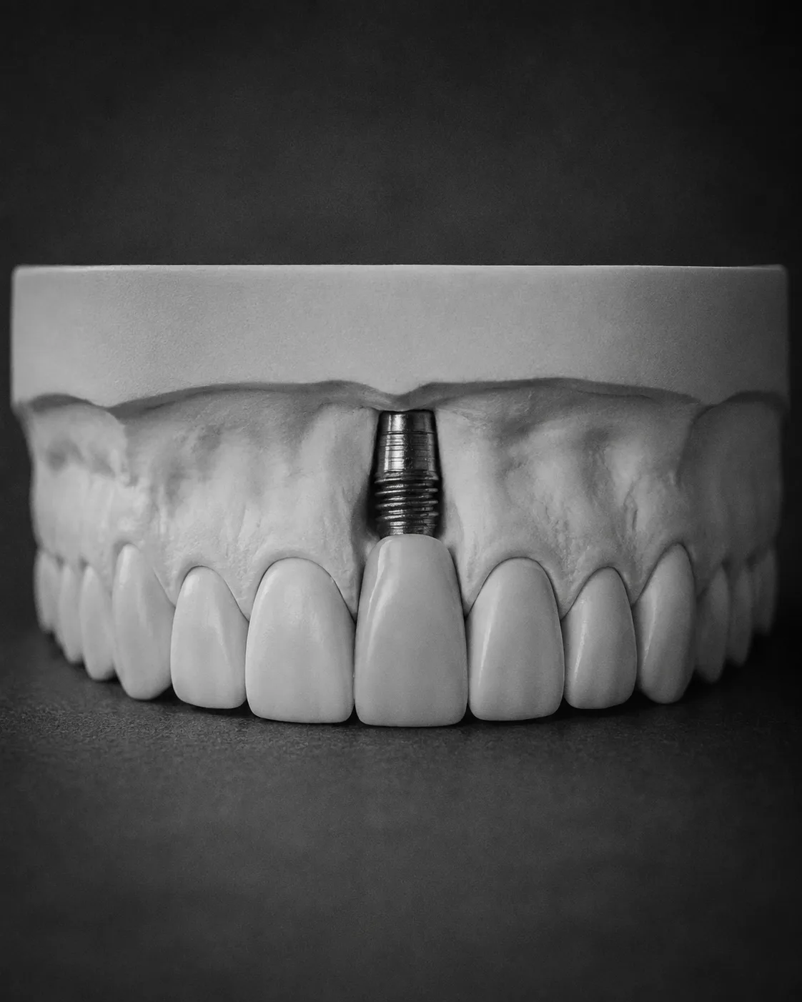 AI-generated dental teaching model: implants integration. Illustrative only; not a patient outcome.